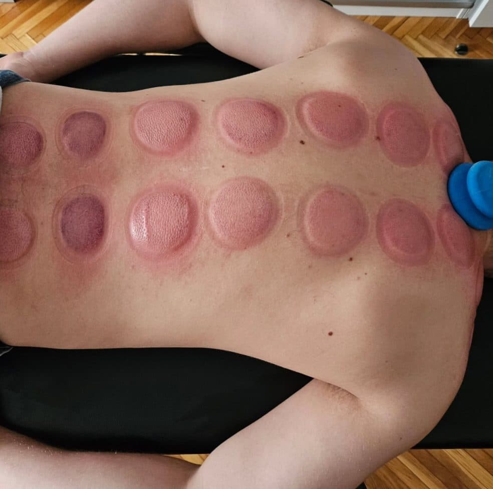 Masaż bańką próżniową